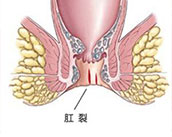 合肥治療肛裂 合肥肛腸專(zhuān)科醫(yī)院 合肥肛門(mén)醫(yī)院哪家好